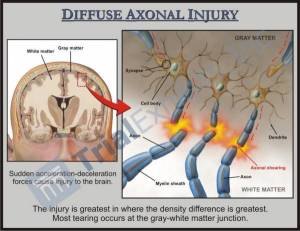 TBI Diffuse Axonal Injury