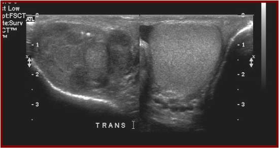 ultrasound testicles